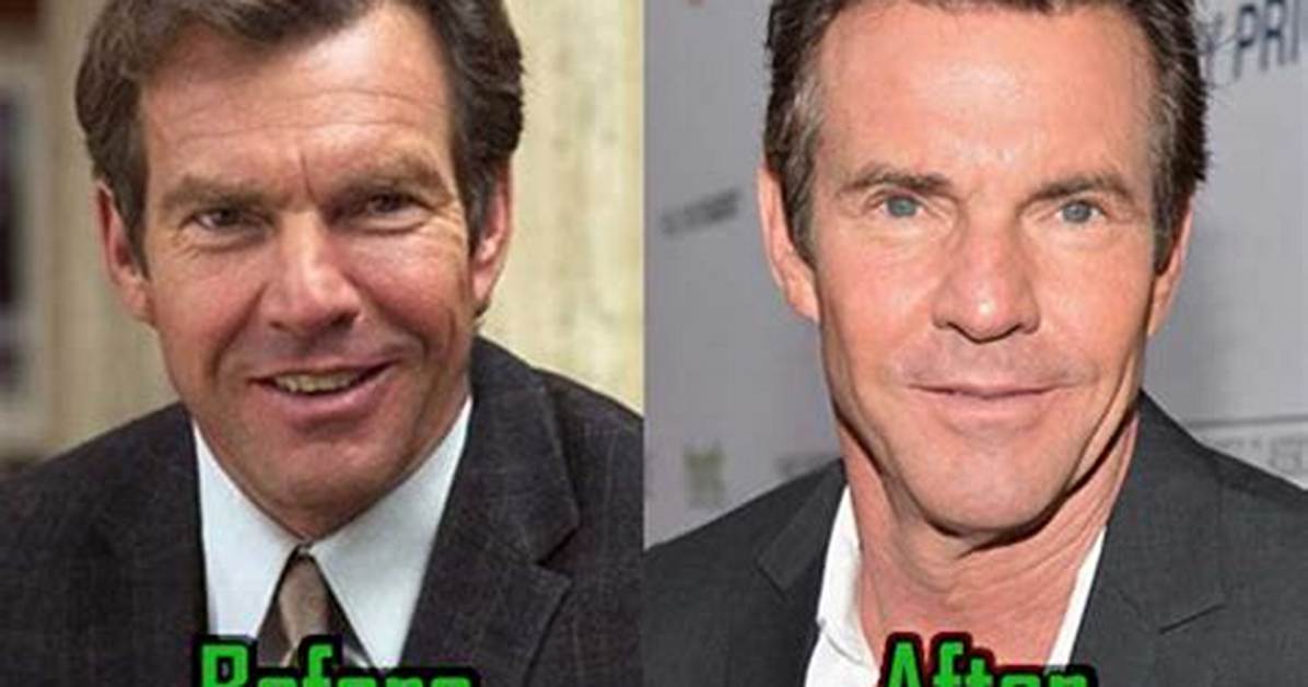 Dennis Quaid Plastic Surgery, Before After Pics – Age and Height Revealed