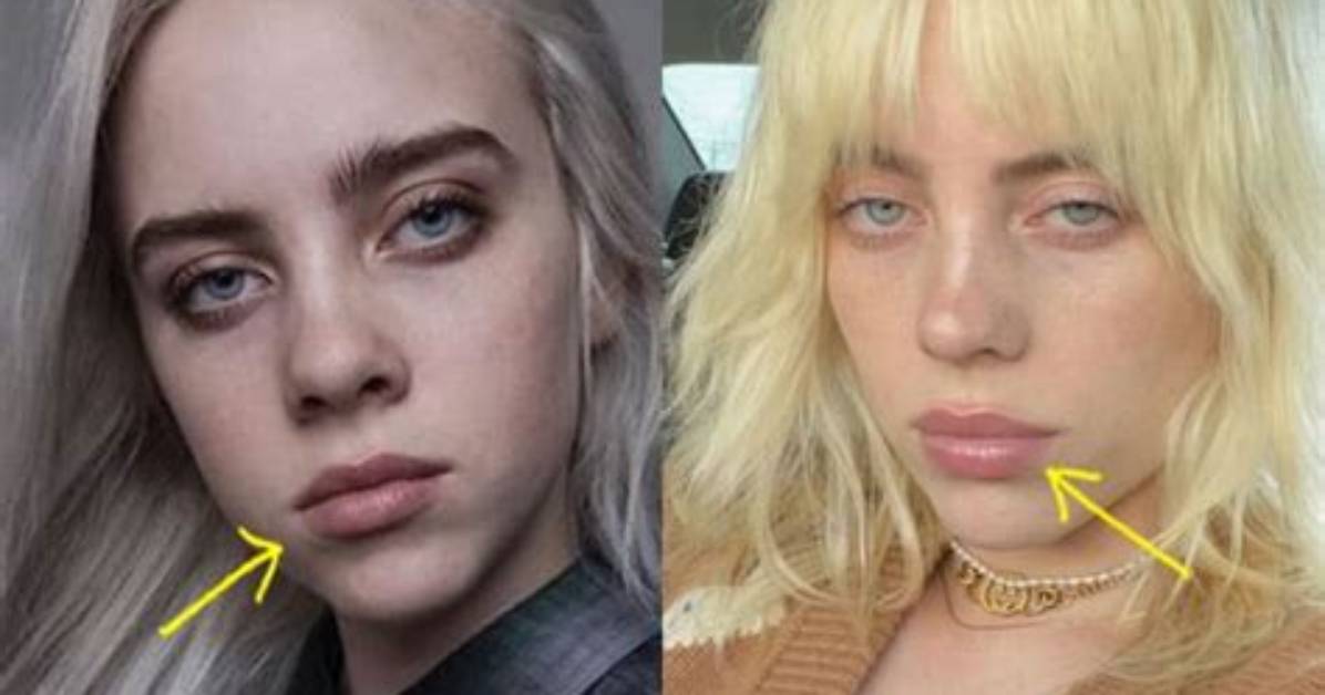 Did Billie Eilish Get a Breast Reduction?