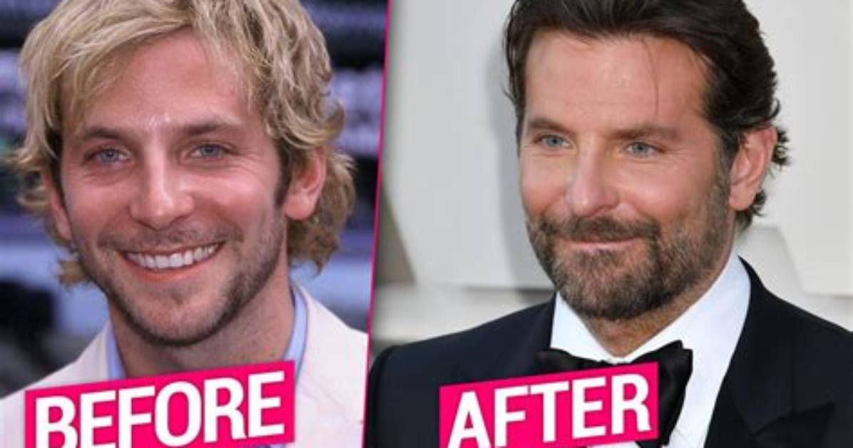 Did Bradley Cooper Get Plastic Surgery Who Is