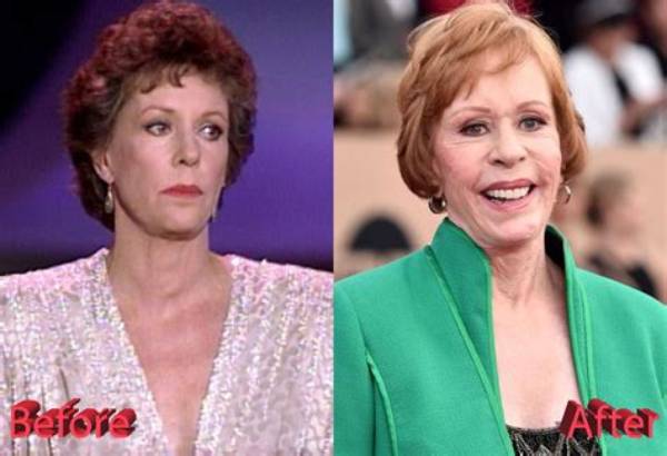 Did Carol Burnett Have Plastic Surgery? Uncovering the Truth