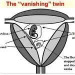 Did I Have a Vanishing Twin?