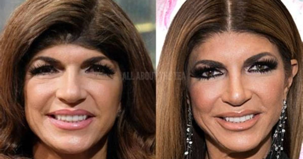 Did Teresa Giudice Have Braces?