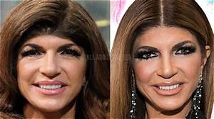 Did Teresa Giudice Have Braces?