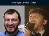 Did Zane Hijazi Just Get Hair Surgery and If Yes, Why?