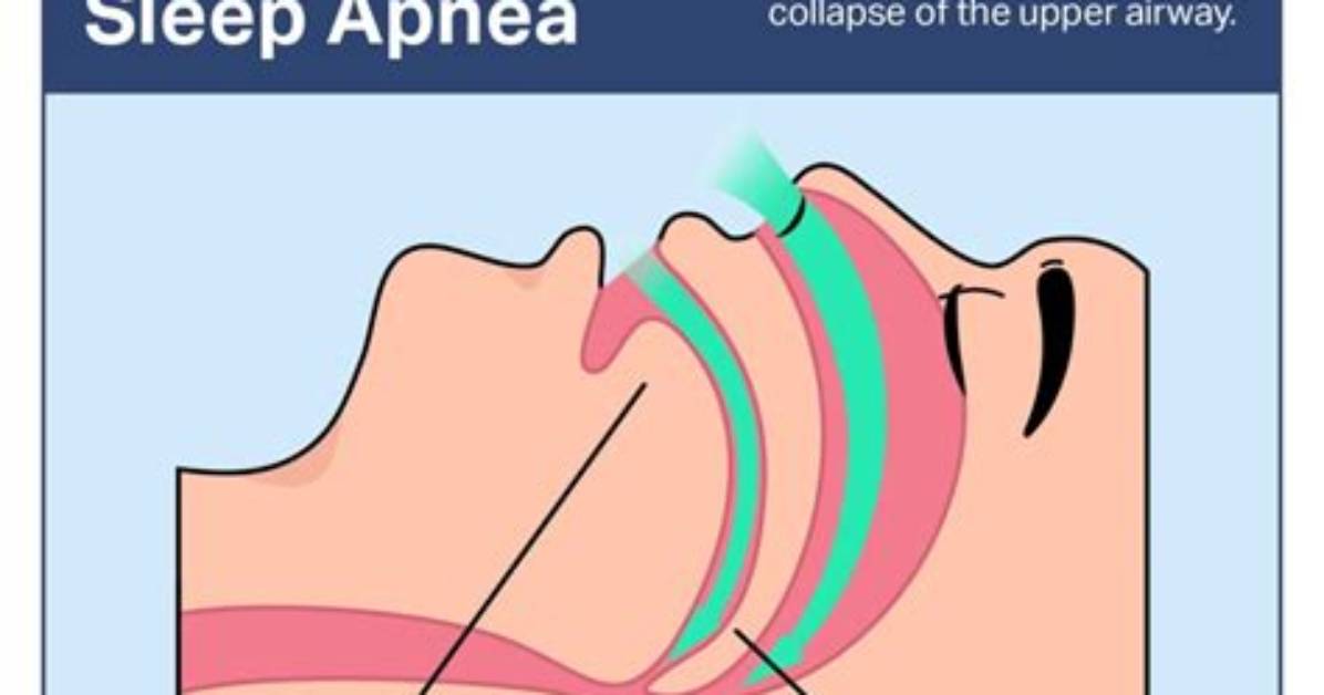 Do Bananas Cause Sleep Apnea?