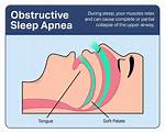 Do Bananas Cause Sleep Apnea?