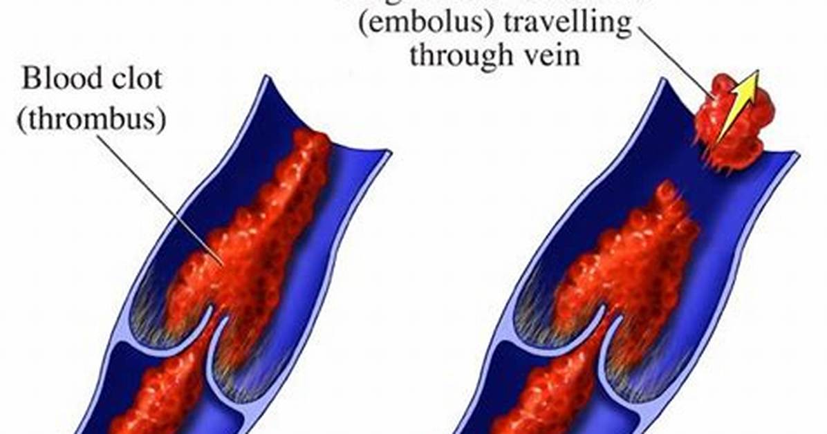 Do Blood Clots Go Away?