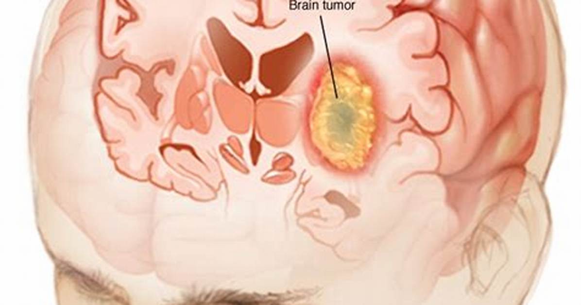 Do Brain Tumors Cause Headaches?