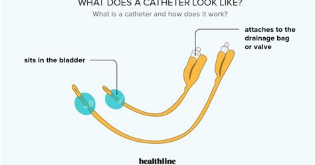 Do Catheters Hurt When Removed?