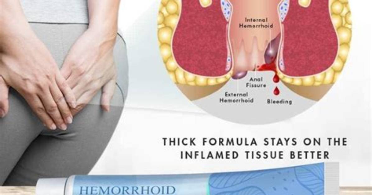 Do Creams Help External Hemorrhoids?