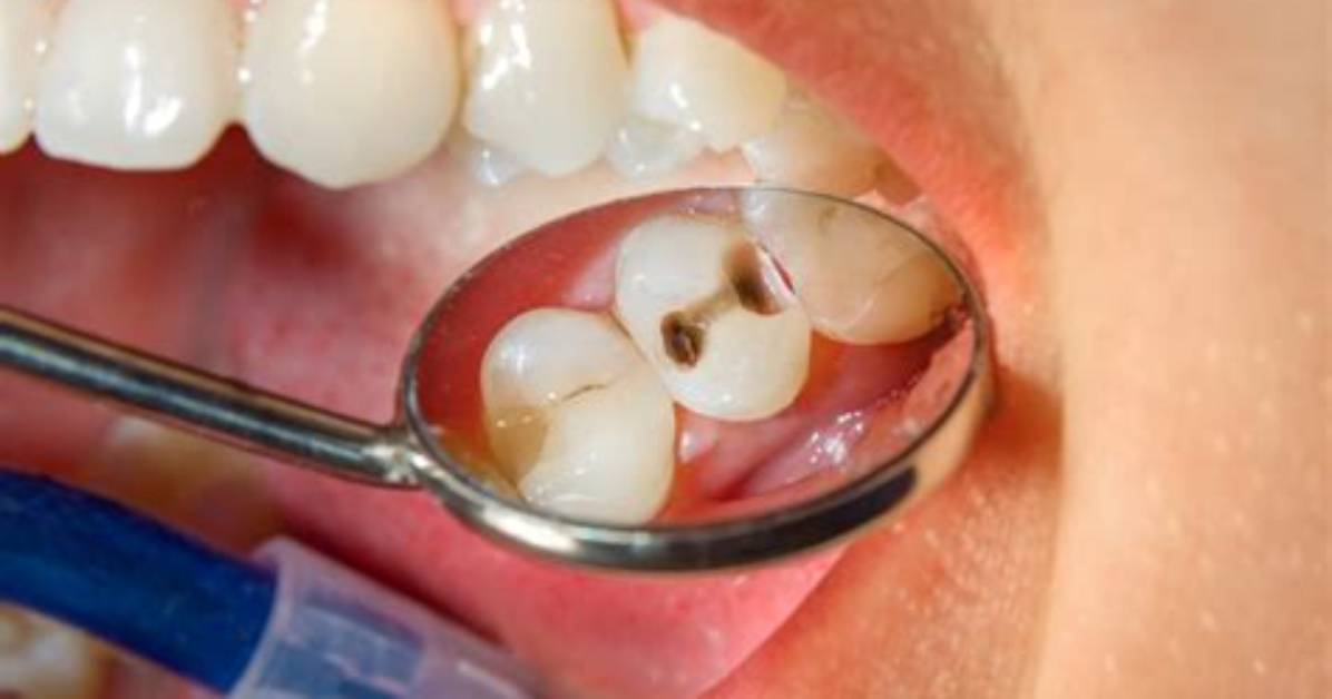 Do Dentists Get Cavities?