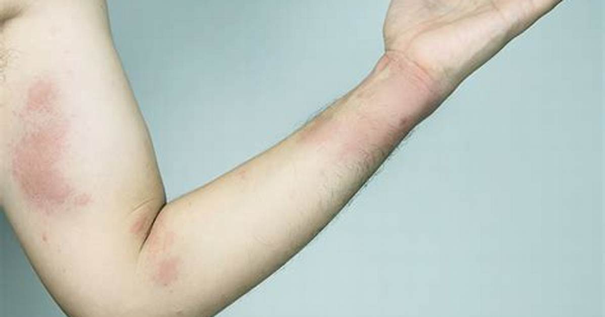 Do Diabetics Bruise Easily?