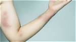 Do Diabetics Bruise Easily?