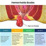 Do External Hemorrhoids Hurt?