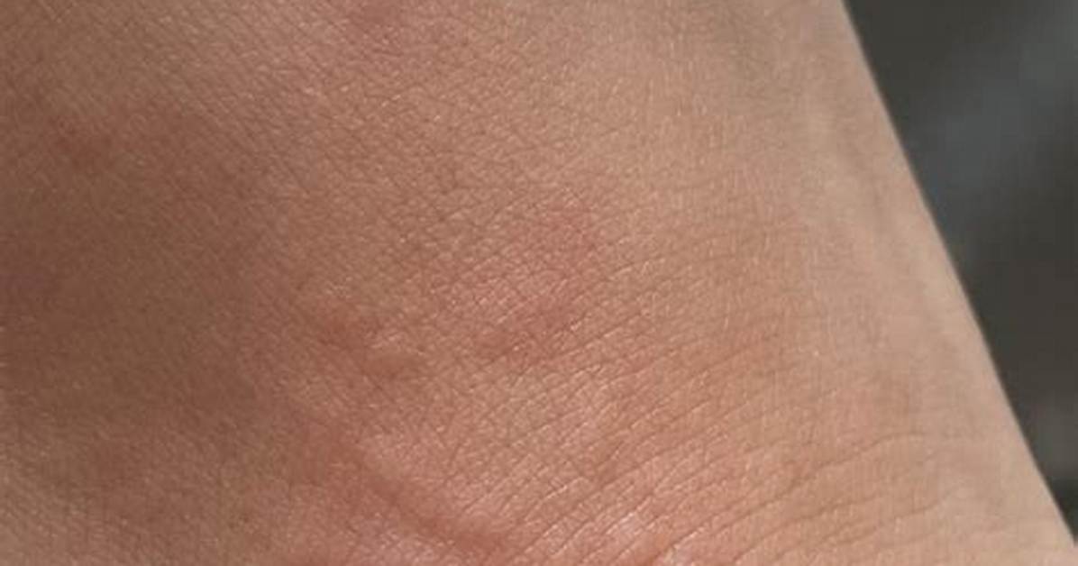Do Hives Spread If You Scratch?