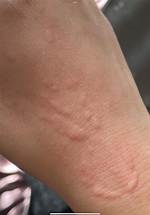 Do Hives Spread If You Scratch?