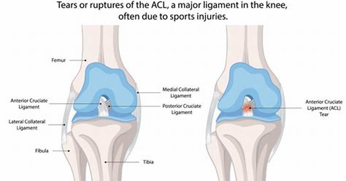 Do Lcl Tears Heal on Their Own?