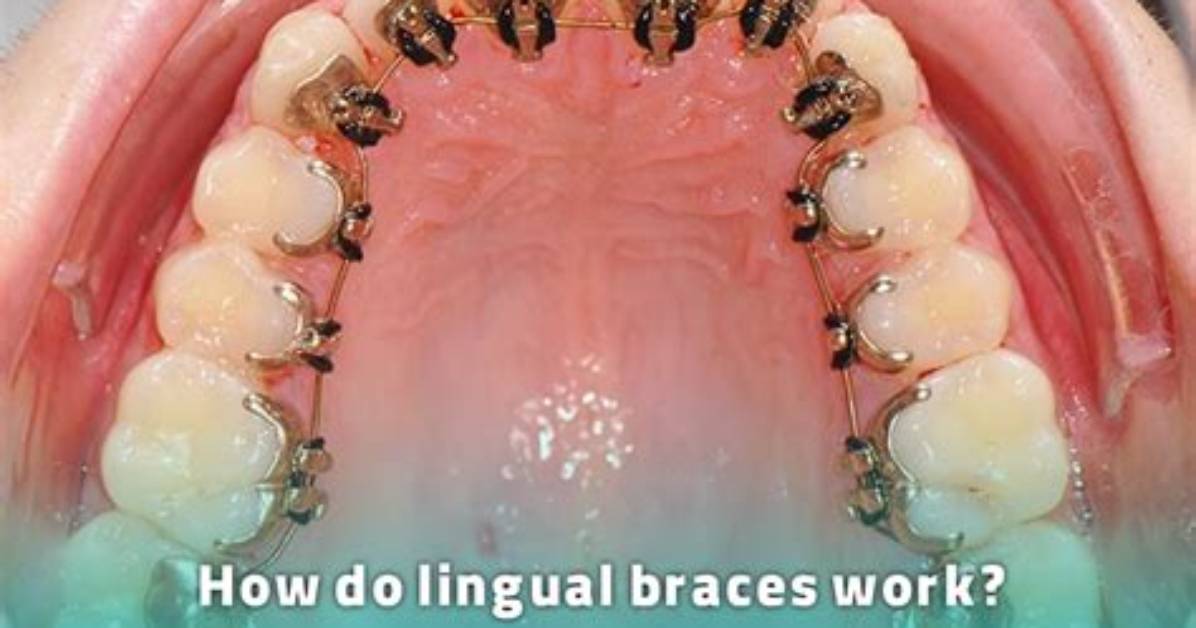 Do Lingual Braces Work?