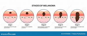 Do Melanomas Grow Quickly?
