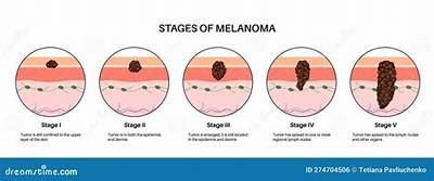 Do Melanomas Grow Quickly?
