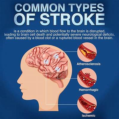 Do People Who Have Strokes Survive?