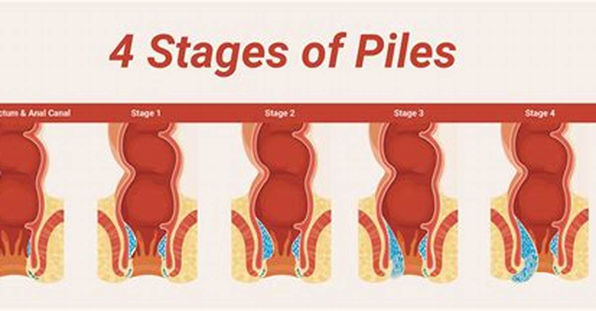 Do Piles Bleed?