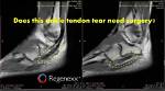 Do Tendons Heal on Their Own?