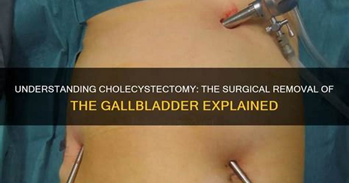 Do They Take out Appendix with Gallbladder?