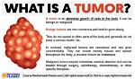 Do Tumors Go Away with Radiation?