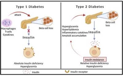 Do Type 1 Diabetics Have a Weaker Immune System?