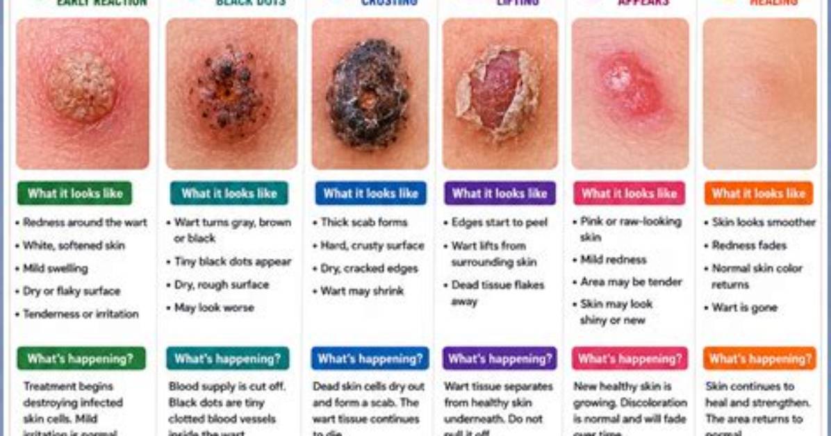 Do Warts Bleed a Lot?