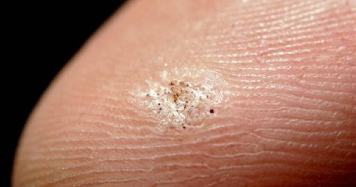 Do Warts Have Seeds?