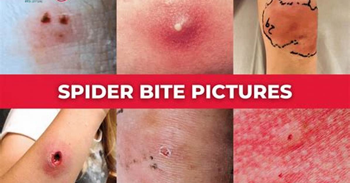 Do You Feel a Spider Bite?