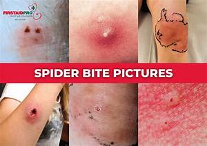 Do You Feel a Spider Bite?
