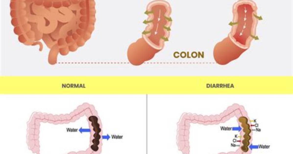 Do You Get Diarrhea When Dehydrated?