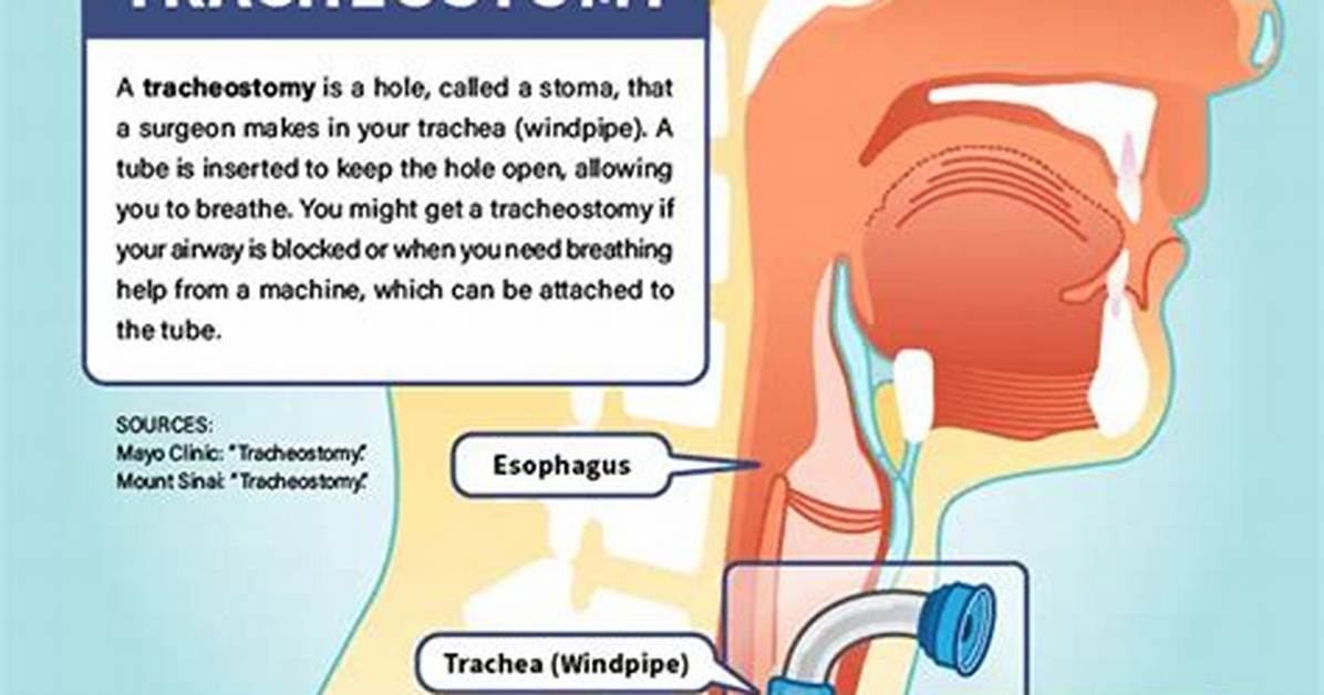 Do You Need a Tracheostomy to Be on a Ventilator?
