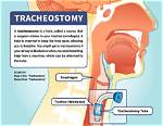Do You Need a Tracheostomy to Be on a Ventilator?