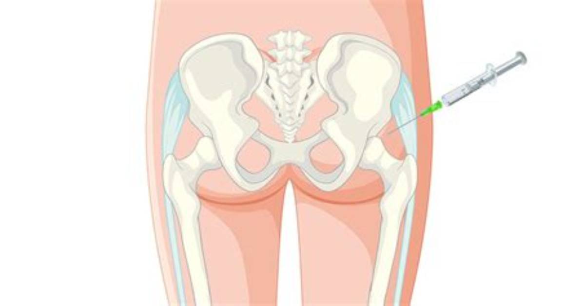 Does a Cortisone Shot in the Hip Bursa Hurt?
