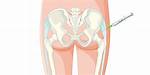Does a Cortisone Shot in the Hip Bursa Hurt?