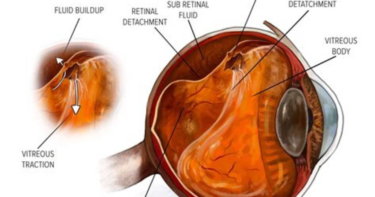 Does a Detached Retina Cause Pain?