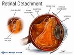 Does a Detached Retina Cause Pain?