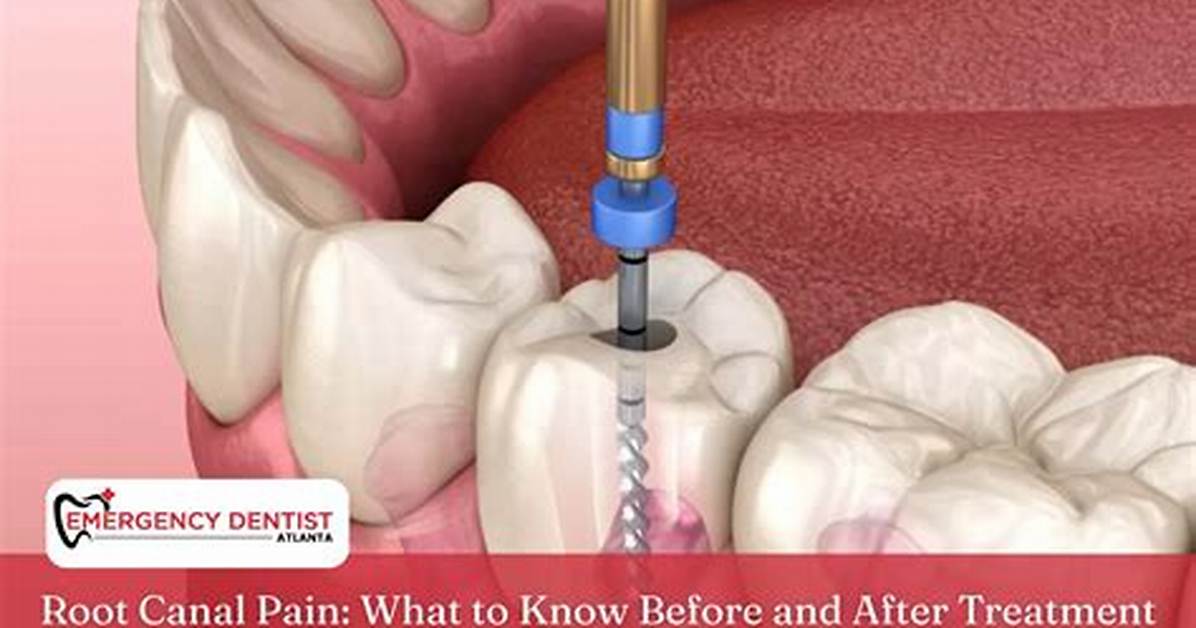 Does a Root Canal Hurt After?