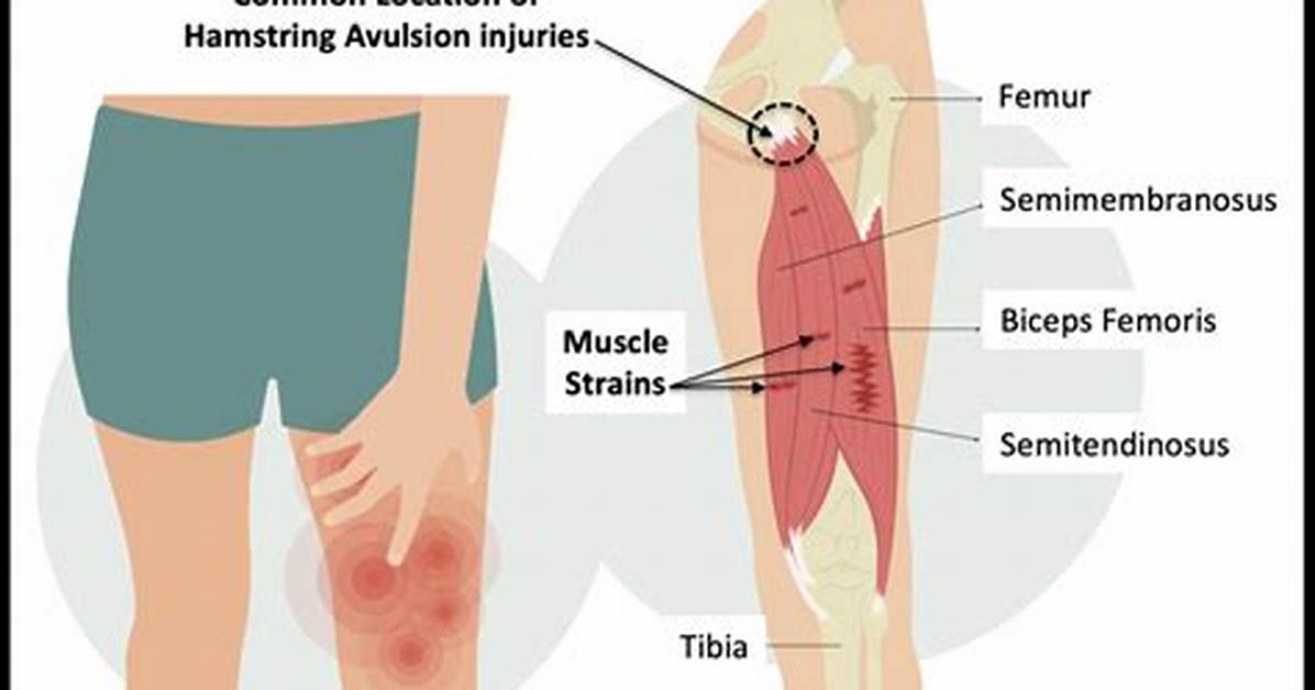 Does a Torn Hamstring Always Bruise?