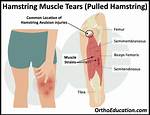 Does a Torn Hamstring Always Bruise?