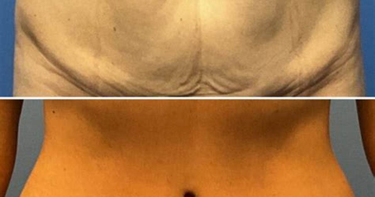 Does a Tummy Tuck Remove Back Fat?
