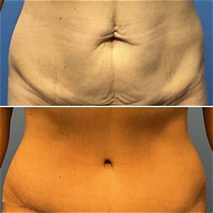 Does a Tummy Tuck Remove Back Fat?