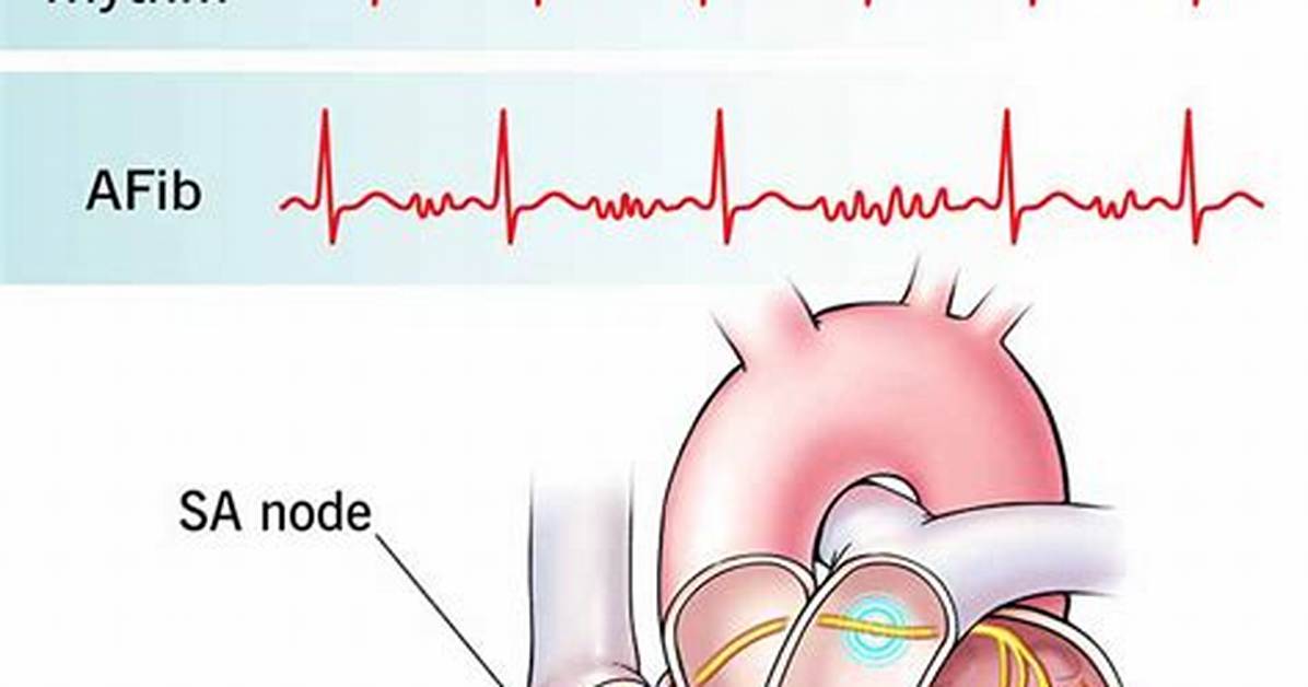 Does Afib Cause Constipation?