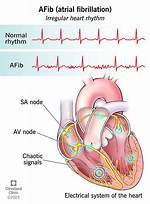Does Afib Cause Constipation?