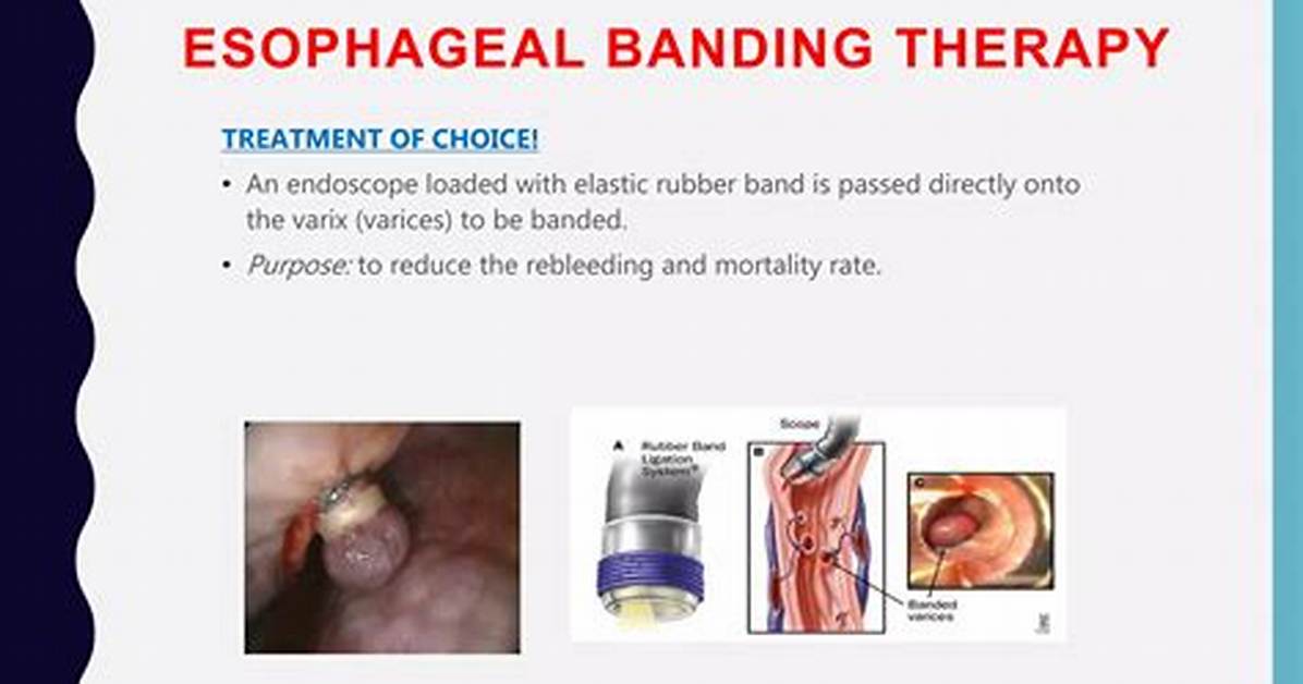 Does Banding Cure Esophageal