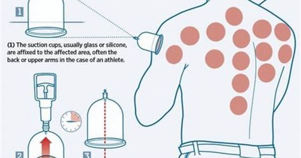 Does Cupping Help with Sleep?